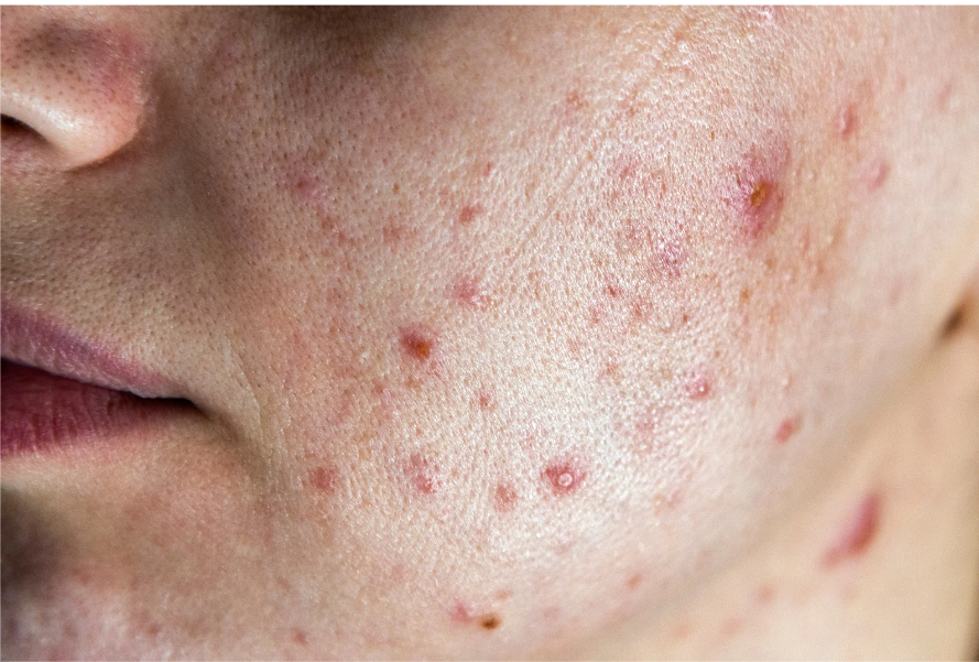 SymptÃ´mes et causes de l'acnÃ© hormonale