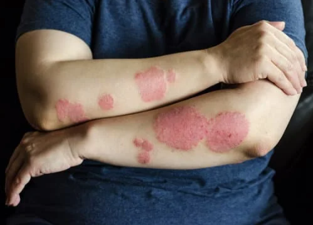 Le psoriasis : quelles sont les complications ? 