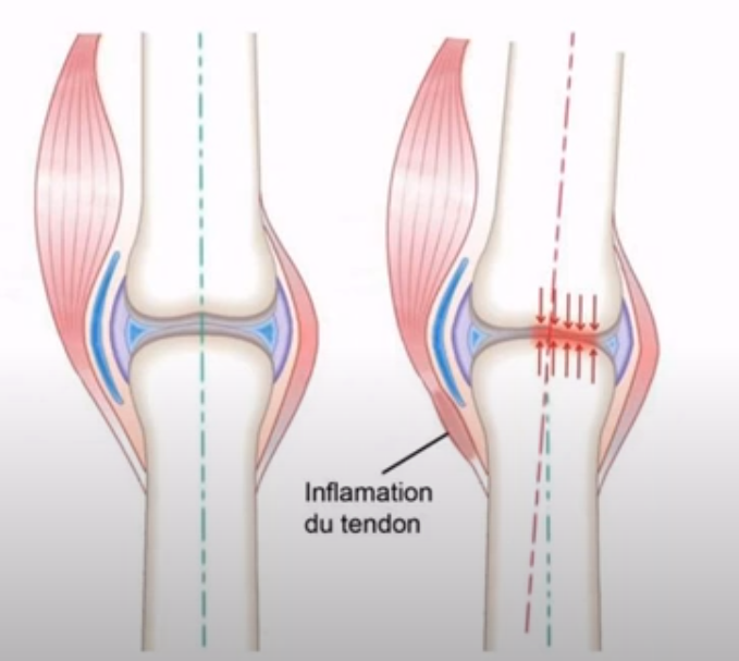 Inflammation tendon : comment la soulager avec un traitement naturel ?