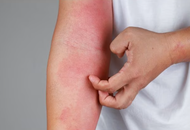Eczéma, qu'est ce que c'est